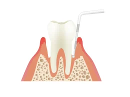 歯周病検査ではどんなことをするの？