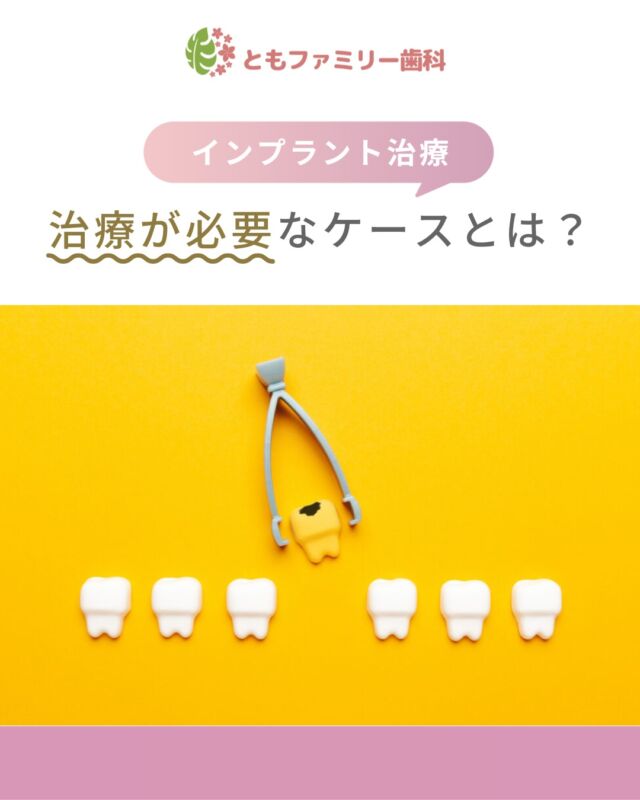 こんにちは！
ともファミリー歯科です😊

インプラント治療が必要なケースについてご紹介いたします！

自然な見た目と機能を再現できるため、
様々な要因で歯を失った場合の治療法として注目されています✨

しかし、口腔内や全身の健康状態に適しているかが重要となり、
中には治療が難しい場合も⚡️！

一人ひとりの口腔内の状態や生活習慣、
全身の健康状態を総合的に考慮し、
適切な治療方法を選ぶことが重要です🌿

⬇️HPもぜひご覧下さい⬇️
https://www.tomo-dent.com/

#歯科医院　#歯ブラシ　#小児歯科　#小児矯正　#小児　#求人　#大阪府　#大阪市　#ともファミリー歯科　#歯科助手　#口腔習慣　#口腔機能　#マルチブラケット装置　#マウスピース　#インプラント矯正　#外科的矯正 #フッ素