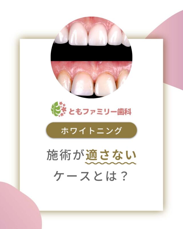 こんにちは！
ともファミリー歯科です😊

歯を白くきれいに見せるホワイトニング
ですが、その施術が適さない
ケースについてご紹介いたします！

様々な原因により
効果を発揮しないケースや、
中には避けた方が良い場合も⚡️

他の方法で歯を白くすることも可能✨なため
歯科医師と相談し、ご自身の歯に適切な
アプローチを検討することが大切です🌿

⬇️HPもぜひご覧下さい⬇️
https://www.tomo-dent.com/

#歯科医院　#歯ブラシ　#小児歯科　#小児矯正　#小児　#求人　#大阪府　#大阪市　#ともファミリー歯科　#歯科助手　#口腔習慣　#口腔機能　#マルチブラケット装置　#マウスピース　#インプラント矯正　#外科的矯正 #フッ素