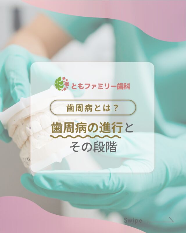 こんにちは！
ともファミリー歯科です😊

歯周病の進行と段階についてご紹介いたします！

成人の約8割が罹患していると言われるほど
非常に身近な病気”歯周病”⚡️
初期段階の歯肉炎であれば、
歯ぐきの炎症を改善し、
健康な組織に回復させることが可能です✨

歯周病は単なる口の中の病気ではありません
全身の健康に影響を及ぼすこともあるため
早期治療と予防が非常に大切です🌿

⬇️HPもぜひご覧下さい⬇️
https://www.tomo-dent.com/

#歯科医院　#歯ブラシ　#小児歯科　#小児矯正　#小児　#求人　#大阪府　#大阪市　#ともファミリー歯科　#歯科助手　#口腔習慣　#口腔機能　#マルチブラケット装置　#マウスピース　#インプラント矯正　#外科的矯正 #フッ素