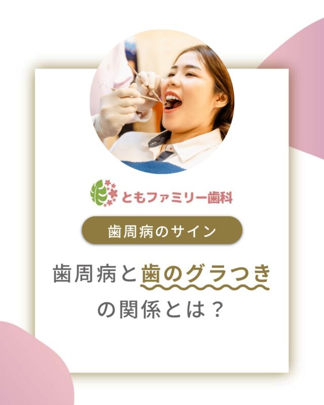 こんにちは！
ともファミリー歯科です😊

歯周病と歯のグラつきの関係についてご紹介いたします！

歯周病が進行すると固定する土台が失われていき
歯がグラグラと動くようになります⚡️

抜歯を避けるためには継続的なメンテナンスで
早期発見と治療が重要です🦷

歯が動く・おかしいな、と思ったら迷わず
歯科医院に相談しましょう🌿

⬇️HPもぜひご覧下さい⬇️
https://www.tomo-dent.com/

#歯科医院　#歯ブラシ　#小児歯科　#小児矯正　#小児　#求人　#大阪府　#大阪市　#ともファミリー歯科　#歯科助手　#口腔習慣　#口腔機能　#マルチブラケット装置　#マウスピース　#インプラント矯正　#外科的矯正 #フッ素
